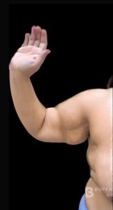 Brachioplasty (Arm Lift) Before and After Pictures Buffalo, NY