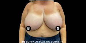 Breast Reduction Before and After Pictures in Buffalo, NY