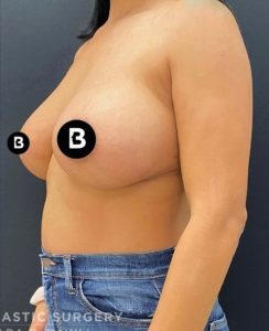 Breast Augmentation Before and After Pictures in Buffalo, NY