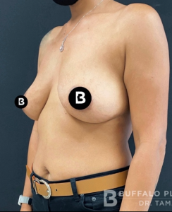 Breast Augmentation Before and After Pictures in Buffalo, NY