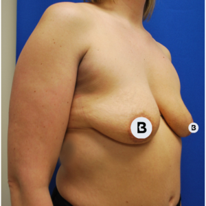 Breast Augmentation Before and After Pictures Buffalo, NY