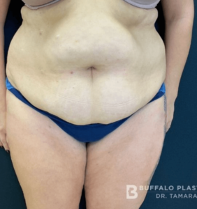 Abdominoplasty (Tummy Tuck) Before and After Pictures in Buffalo, NY