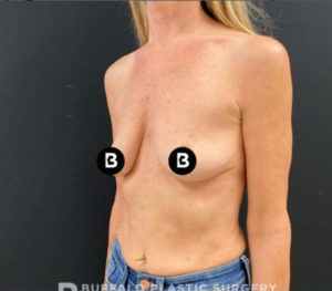 Breast Augmentation Before and After Pictures in Buffalo, NY