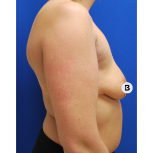 Breast Augmentation Before and After Pictures Buffalo, NY