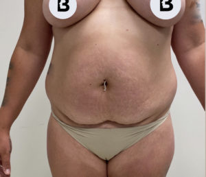 Abdominoplasty (Tummy Tuck) Before and After Pictures Buffalo, NY