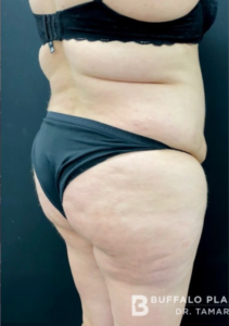Brazilian Butt Lift Before and After Pictures in Buffalo, NY