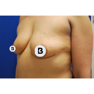 Breast Augmentation Before and After Pictures Buffalo, NY