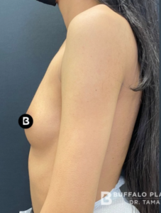 Breast Augmentation Before and After Pictures in Buffalo, NY