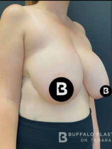 Breast Reduction Before and After Pictures in Buffalo, NY