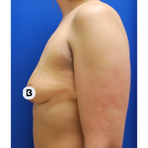 Breast Augmentation Before and After Pictures Buffalo, NY