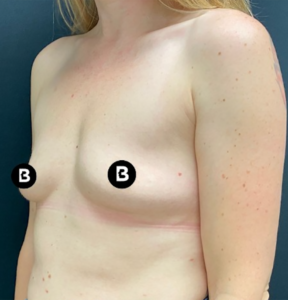 Breast Augmentation Before and After Pictures in Buffalo, NY