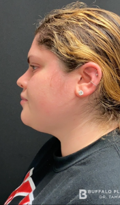Chin Liposuction Before and After Pictures Buffalo, NY