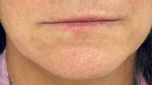 Lip Fillers Before and After Pictures in Buffalo, NY