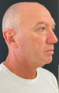 Necklift Before and After Pictures in Buffalo, NY