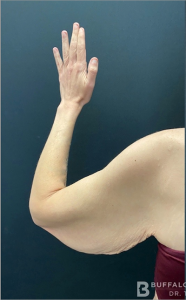 Brachioplasty (Arm Lift) Before and After Pictures Buffalo, NY
