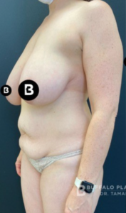 Mommy Makeover Before and After Pictures in Buffalo, NY