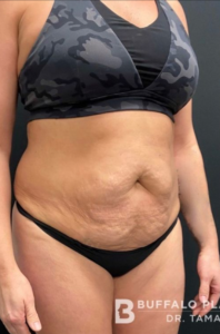 Breast Augmentation Before and After Pictures in Buffalo, NY