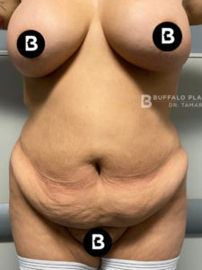 Abdominoplasty (Tummy Tuck) Before and After Pictures in Buffalo, NY