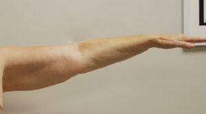 Arm Liposuction Before and After Pictures Buffalo, NY