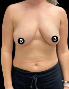Breast Augmentation Before and After Pictures in Buffalo, NY