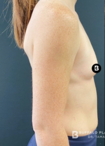 Breast Augmentation Before and After Pictures in Buffalo, NY