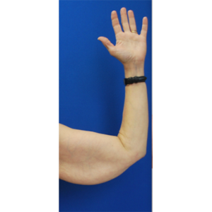 Brachioplasty (Arm Lift) Before and After Pictures Buffalo, NY