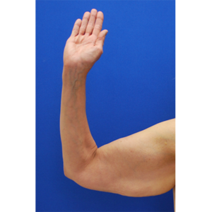 Brachioplasty (Arm Lift) Before and After Pictures Buffalo, NY