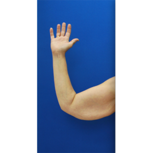 Brachioplasty (Arm Lift) Before and After Pictures Buffalo, NY