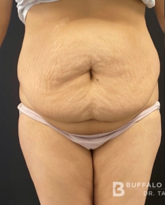 Abdominoplasty (Tummy Tuck) Before and After Pictures in Buffalo, NY
