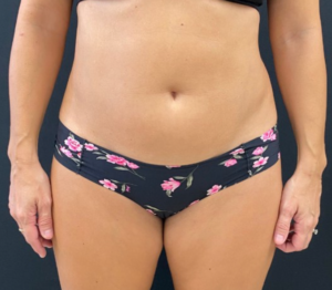 Liposuction Before and After Pictures in Buffalo, NY