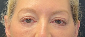 Blepharoplasty (Eyelid Surgery) Before and After Pictures in Buffalo, NY