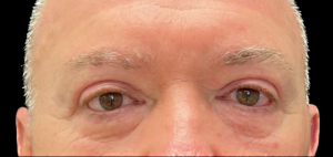 Blepharoplasty (Eyelid Surgery) Before and After Pictures in Buffalo, NY