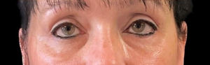 Blepharoplasty (Eyelid Surgery) Before and After Pictures in Buffalo, NY