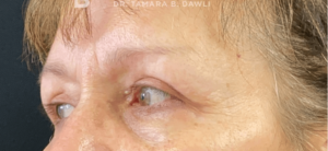 Blepharoplasty (Eyelid Surgery) Before and After Pictures in Buffalo, NY