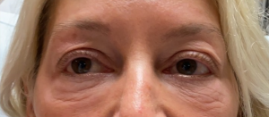 Blepharoplasty (Eyelid Surgery) Before and After Pictures in Buffalo, NY