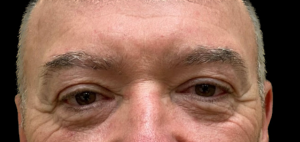 Blepharoplasty (Eyelid Surgery) Before and After Pictures in Buffalo, NY
