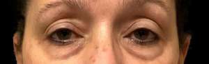 Blepharoplasty (Eyelid Surgery) Before and After Pictures in Buffalo, NY