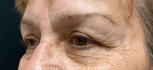 Blepharoplasty (Eyelid Surgery) Before and After Pictures in Buffalo, NY