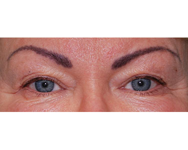 Blepharoplasty Before and After Pictures Buffalo, NY