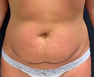 Abdominoplasty (Tummy Tuck) Before and After Pictures in Buffalo, NY