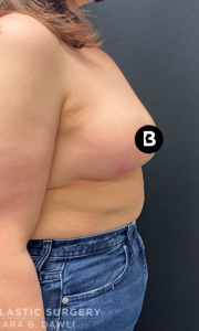 Breast Reduction Before and After Pictures in Buffalo, NY