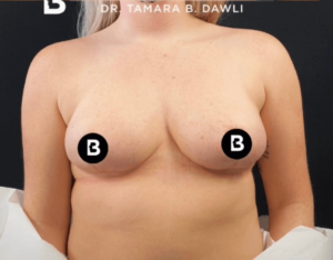Breast Reduction Before and After Pictures in Buffalo, NY