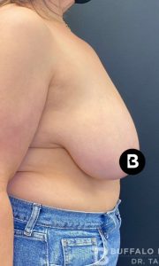 Breast Reduction Before and After Pictures in Buffalo, NY