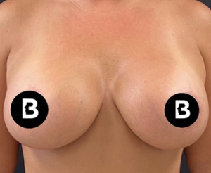 Breast Augmentation Before and After Pictures in Buffalo, NY