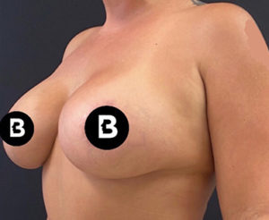 Breast Augmentation Before and After Pictures in Buffalo, NY
