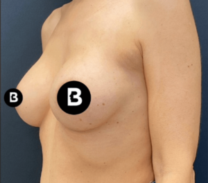 Breast Augmentation Before and After Pictures in Buffalo, NY