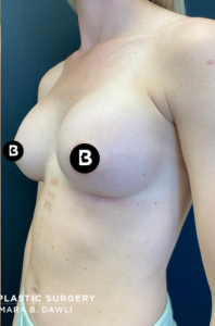 Breast Augmentation Before and After Pictures in Buffalo, NY