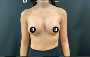 Breast Augmentation Before and After Pictures in Buffalo, NY