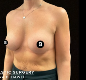 Breast Augmentation Before and After Pictures in Buffalo, NY