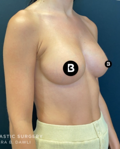 Breast Augmentation Before and After Pictures in Buffalo, NY